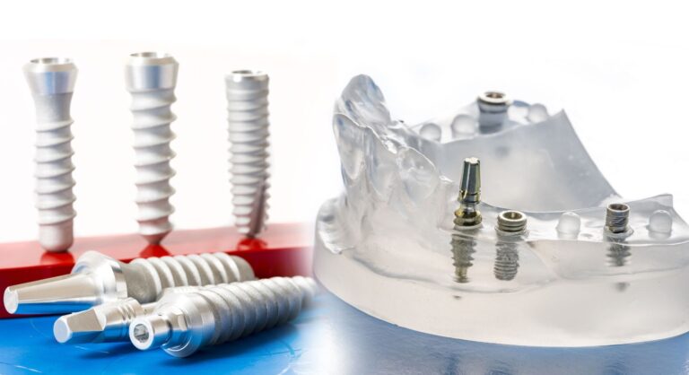 Ar dantų implantai – visam gyvenimui? Mitai ir realybė